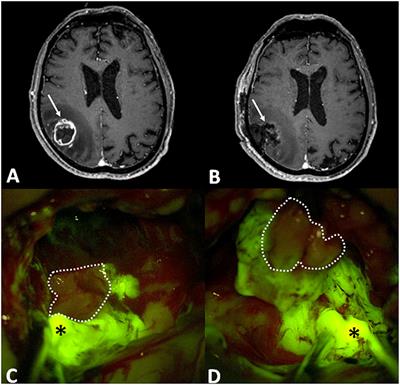 Fluorescein Application in Cranial and Spinal Tumors Enhancing at Preoperative MRI and Operated With a Dedicated Filter on the Surgical Microscope: Preliminary Results in 279 Patients Enrolled in the FLUOCERTUM Prospective Study